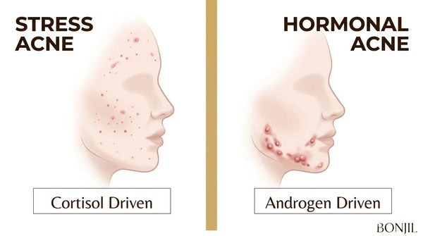 Stress acne vs hormonal acne comparison showing cortisol-driven breakouts and androgen-driven breakouts